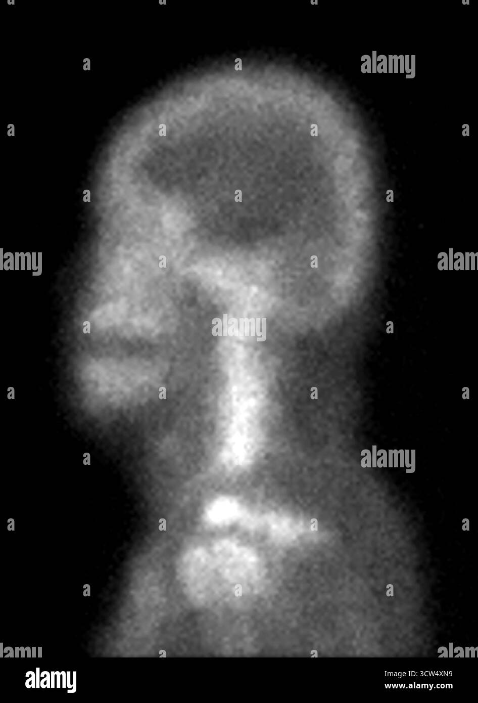 La scansione ossea dell'intero corpo è stata eseguita dopo l'iniezione endovenosa di TC-99m MDP, senza evidenza definitiva di metastasi ossee. Foto Stock