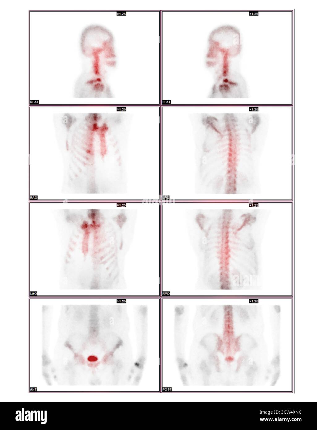 La scansione ossea dell'intero corpo è stata eseguita dopo l'iniezione endovenosa di TC-99m MDP, senza evidenza definitiva di metastasi ossee. Foto Stock