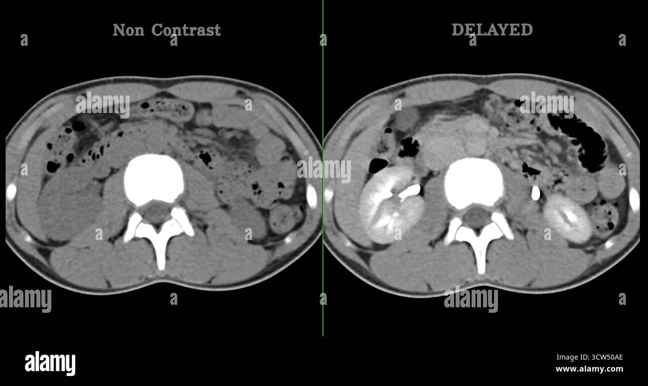 Scansione TC ad alta risoluzione addome inferiore che mostra un normale addome inferiore, perfetto per l'educazione medica, riferimento diagnostico e presentazioni sanitarie. Foto Stock