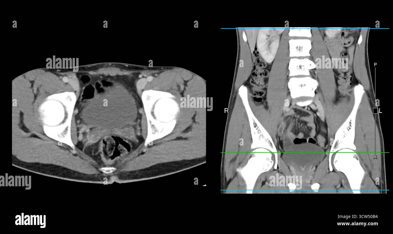 Scansione TC ad alta risoluzione addome inferiore che mostra un normale addome inferiore, perfetto per l'educazione medica, riferimento diagnostico e presentazioni sanitarie. Foto Stock