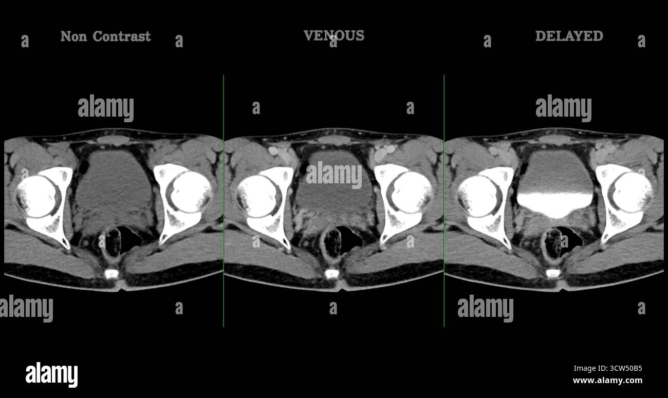 Scansione TC ad alta risoluzione addome inferiore che mostra un normale addome inferiore, perfetto per l'educazione medica, riferimento diagnostico e presentazioni sanitarie. Foto Stock