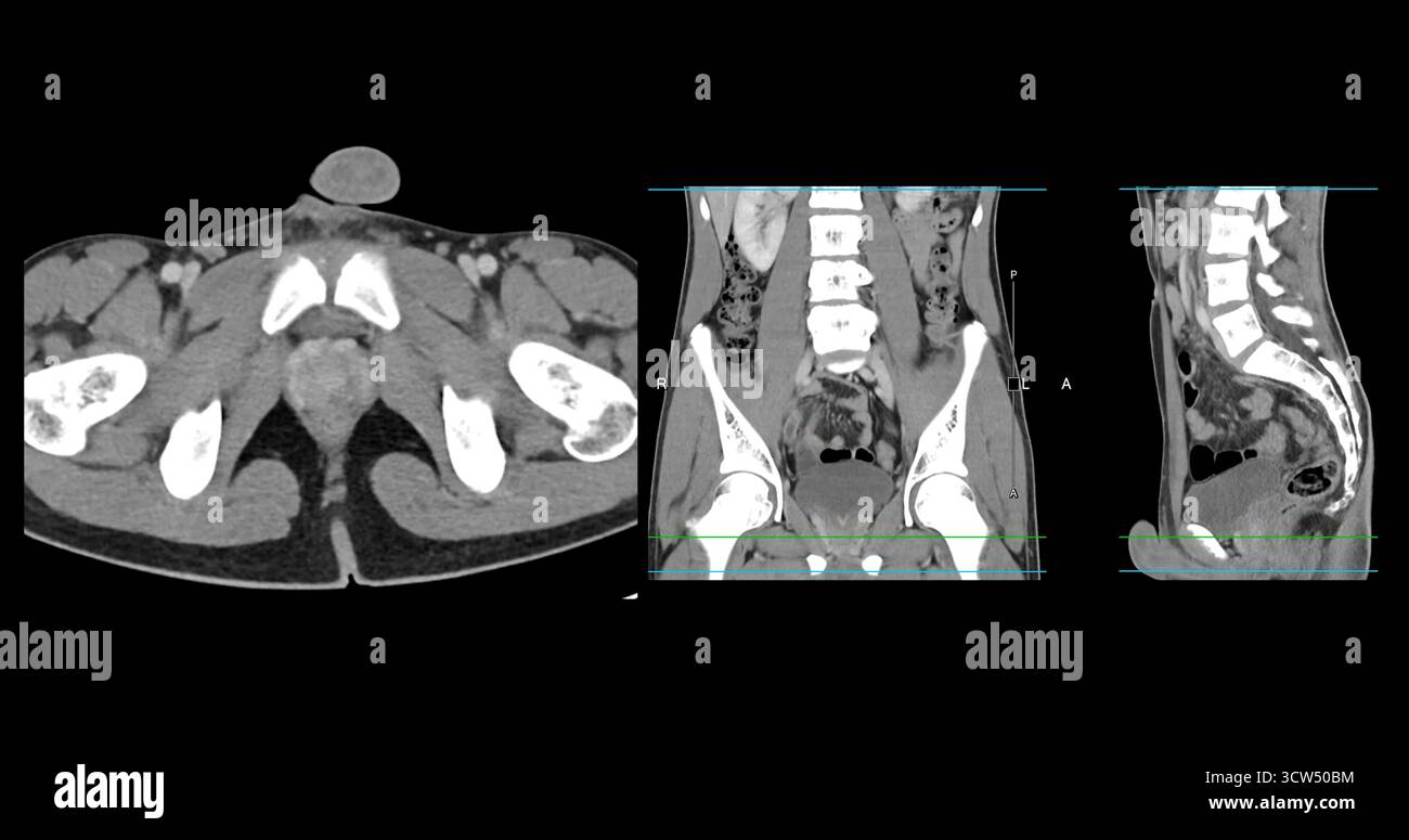 Scansione TC ad alta risoluzione addome inferiore che mostra un normale addome inferiore, perfetto per l'educazione medica, riferimento diagnostico e presentazioni sanitarie. Foto Stock