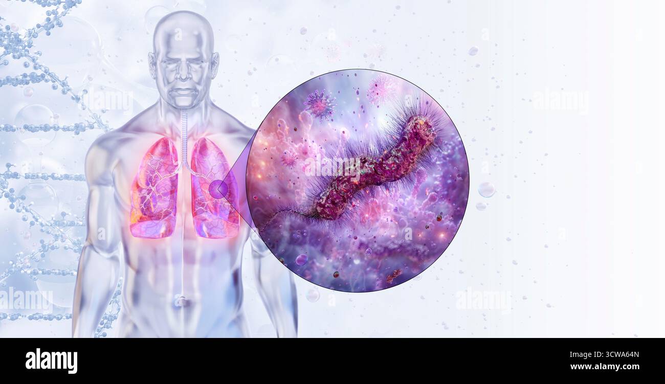 Infezione da Legionella pneumophila, illustrazione. La Legionella pneumophila è un batterio Gram-negativo responsabile della malattia di Legionnairesâ€™, una grave forma di polmonite. Foto Stock