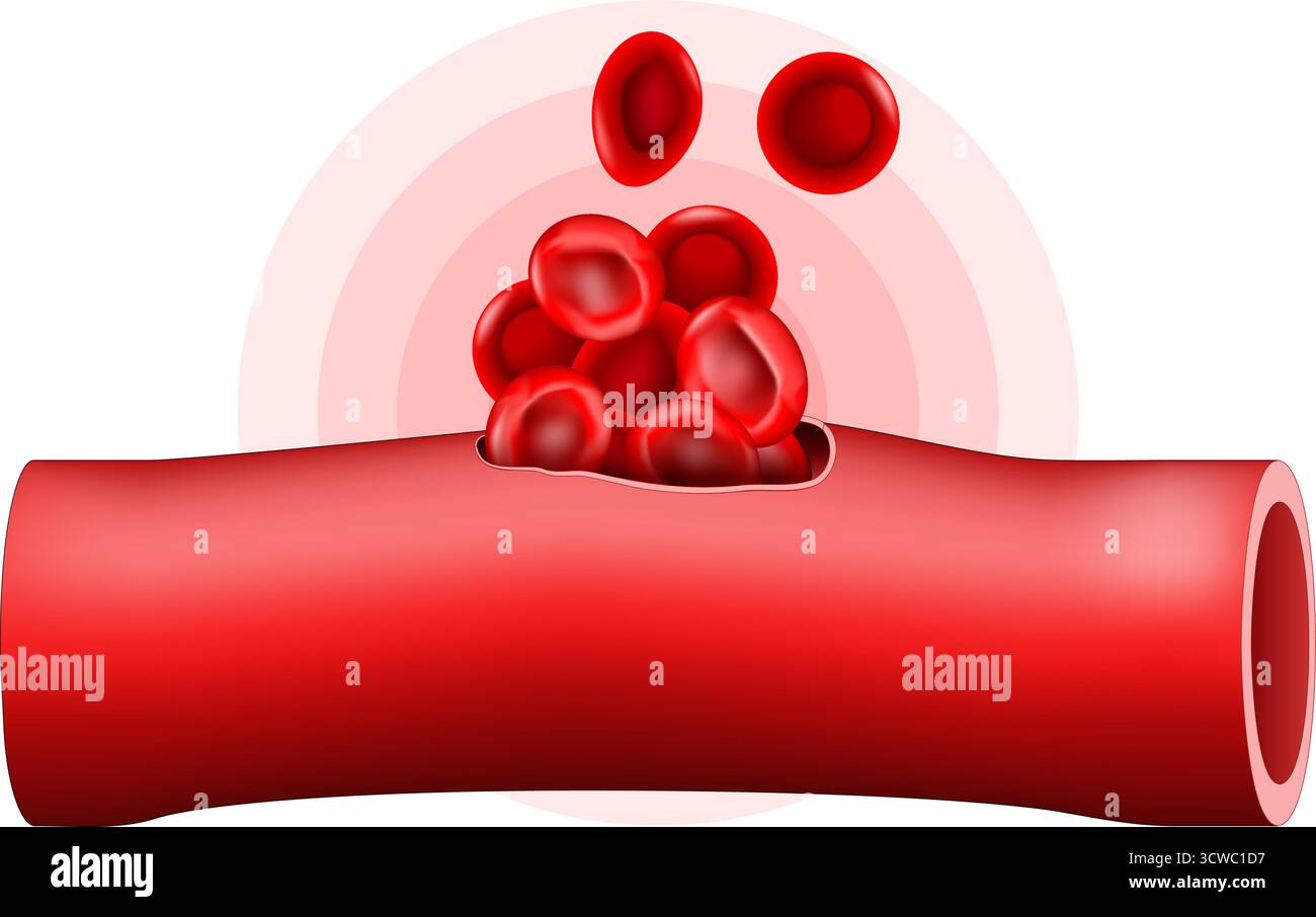 Ematoma. Vaso sanguigno dopo trauma. Primo piano dei globuli rossi. Sanguinamento localizzato all'esterno dei vasi sanguigni. Illustrazione vettoriale Illustrazione Vettoriale