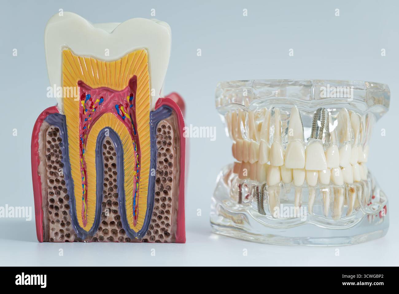 Modelli dentali educativi che mostrano la struttura interna dei denti e impianti dentali utilizzati per la formazione medica e scopi di spiegazione del paziente. Foto Stock