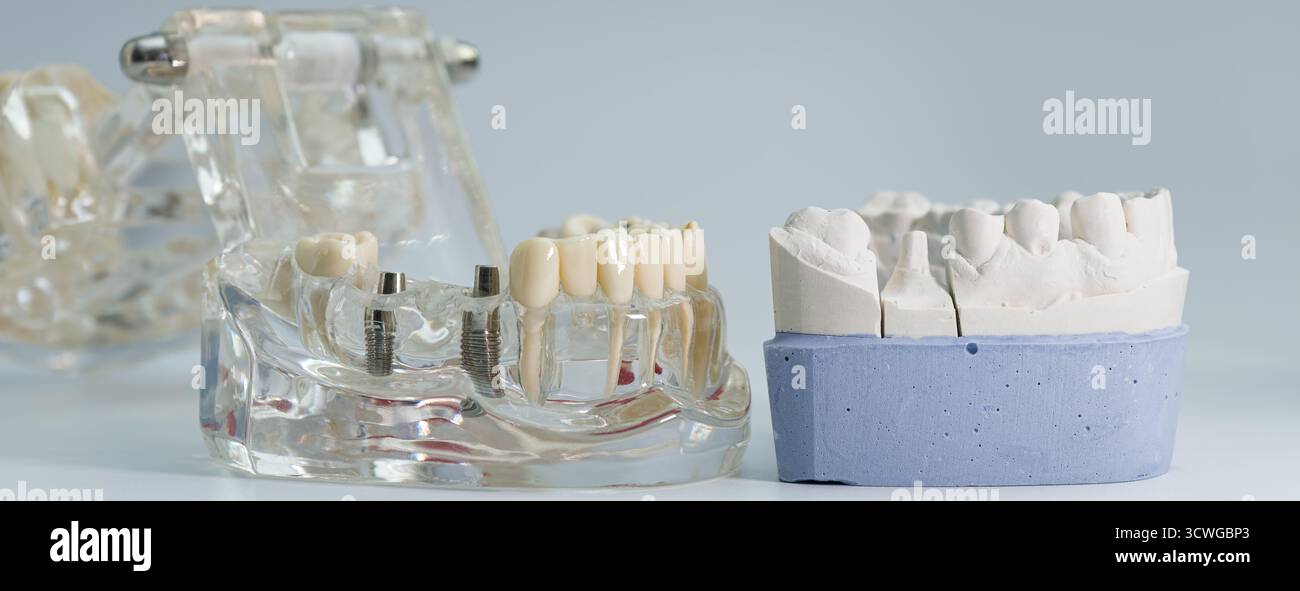 Vista dettagliata dei modelli di ganasce trasparenti e in gesso che mostrano impianti dentali e corone utilizzate per l'odontoiatria rigenerativa e per la formazione. Foto Stock