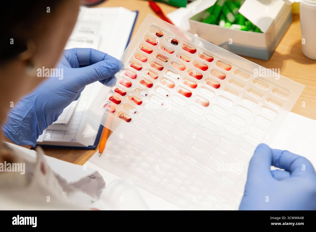 Il terapeuta utilizza la tavolozza dei campioni di sangue e le sostanze chimiche per il rilevamento del tipo di sangue Foto Stock