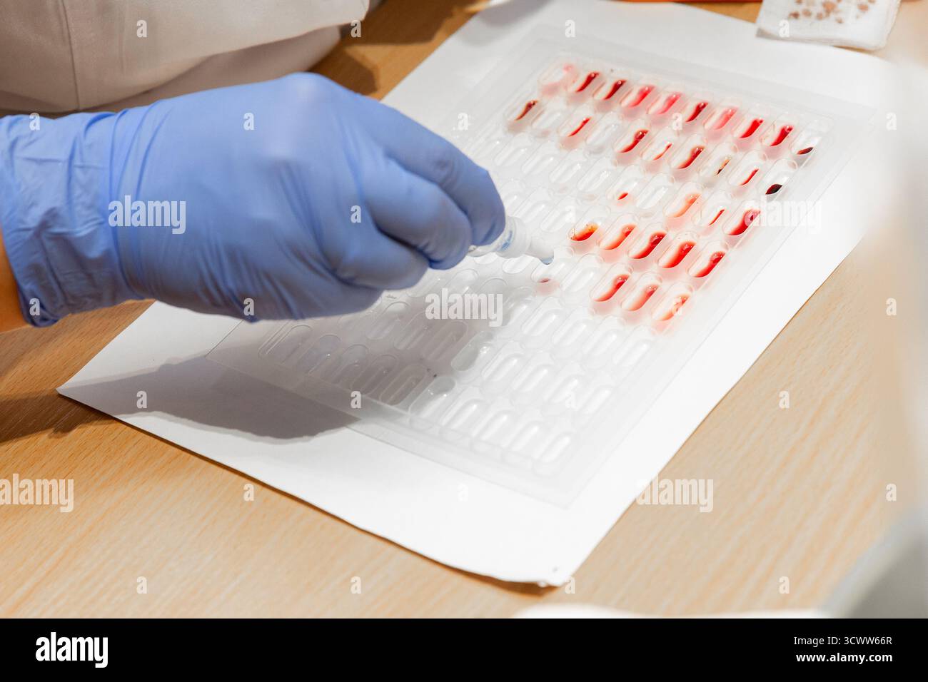 Il terapeuta utilizza la tavolozza dei campioni di sangue e le sostanze chimiche per il rilevamento del tipo di sangue Foto Stock