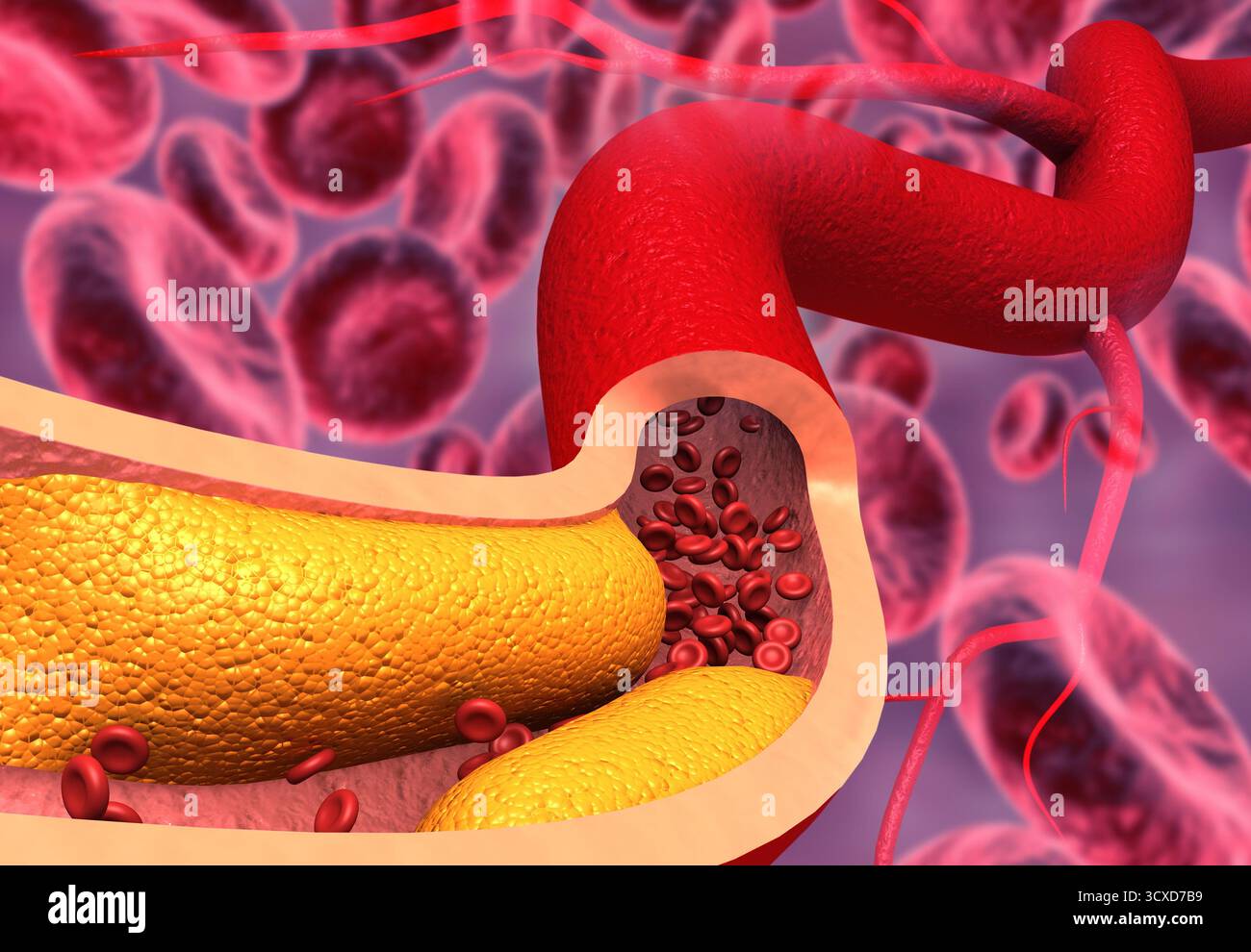 Arterie ostruite, placca di colesterolo nell'arteria. illustrazione 3d. Foto Stock