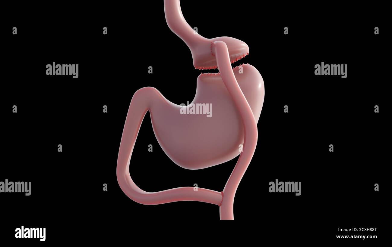 Un'immagine 3d illustra l'intervento di bypass gastrico che modifica il sistema digerente per aiutare a perdere peso. Tipo principale di intervento chirurgico a perdita di peso (bariatrico). Foto Stock