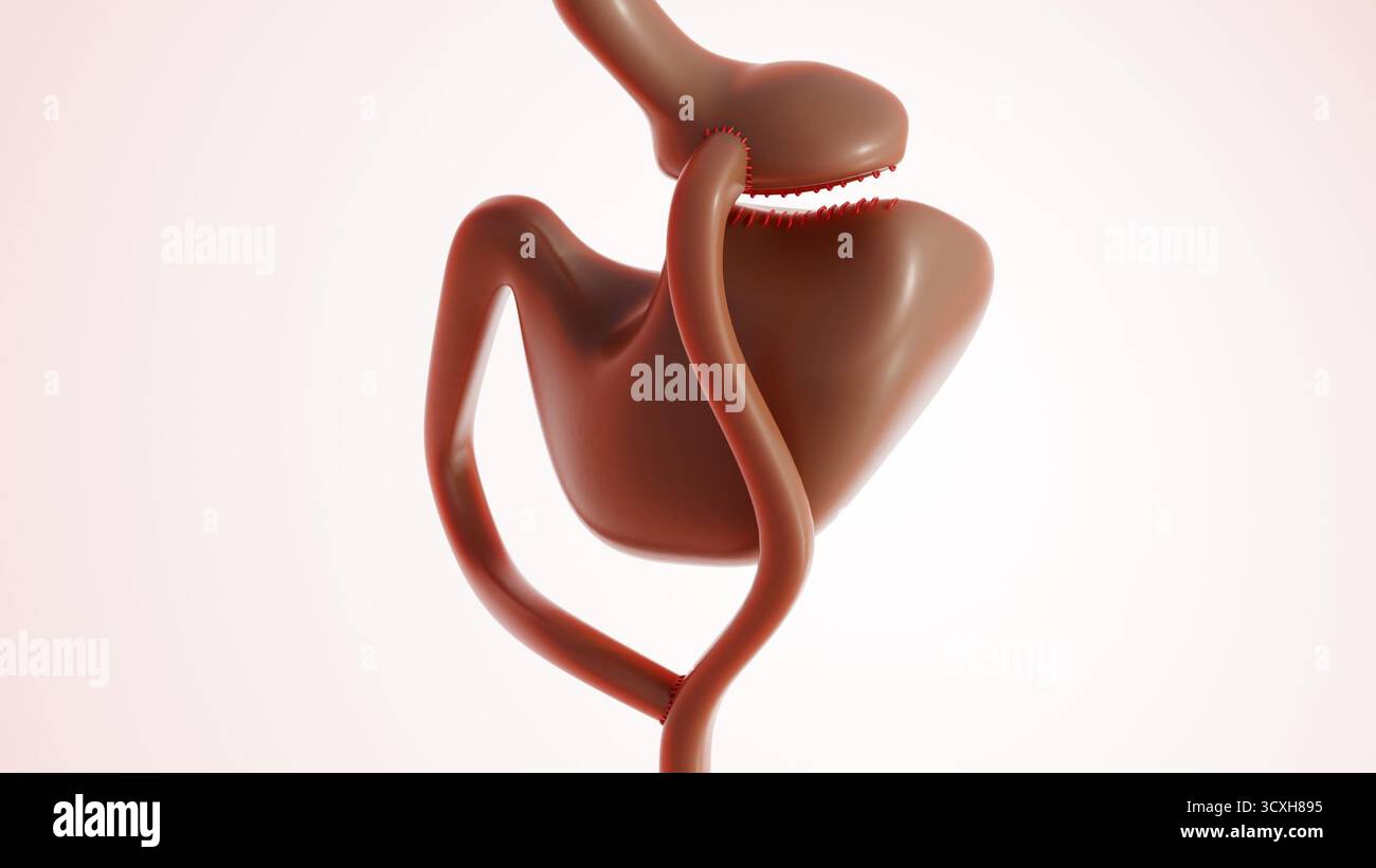 Un'immagine 3d illustra l'intervento di bypass gastrico che modifica il sistema digerente per aiutare a perdere peso. Tipo principale di intervento chirurgico a perdita di peso (bariatrico). Foto Stock