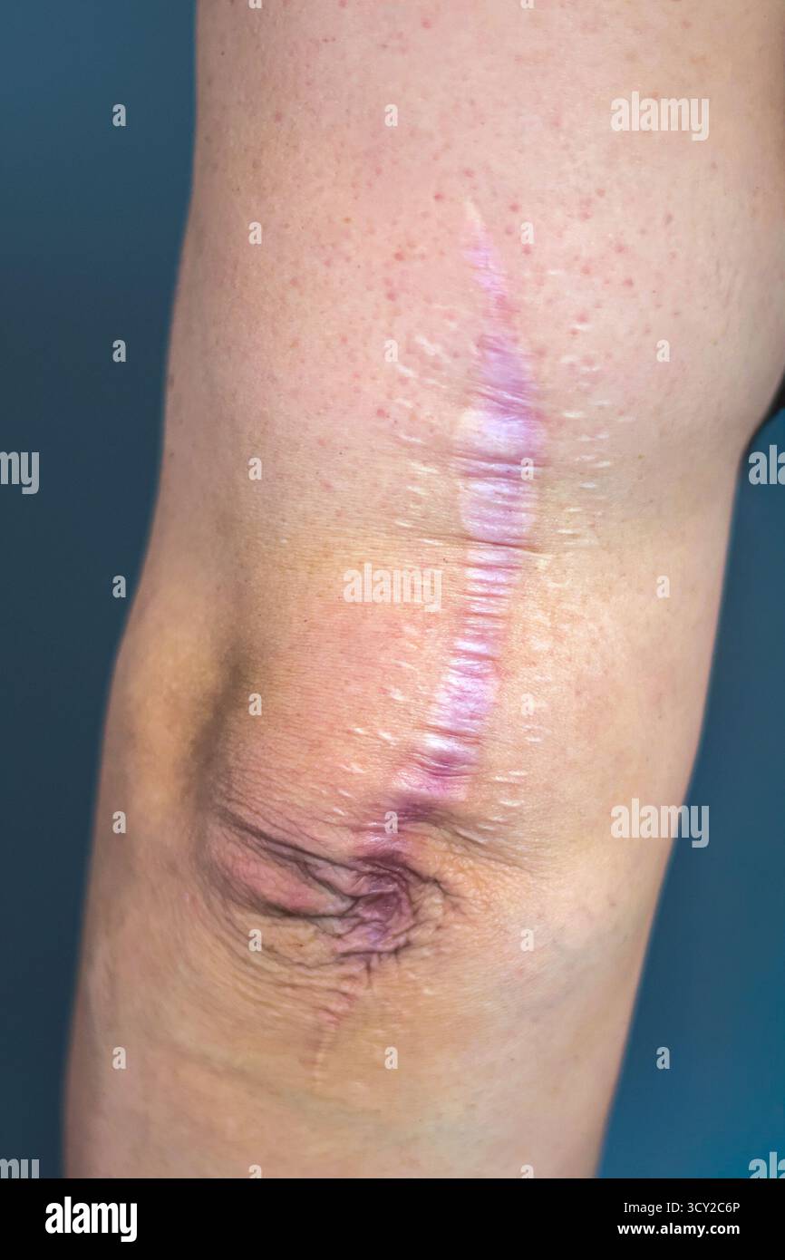 Ginocchio con una vecchia cicatrice chirurgica sulla pelle, che mostra il processo di guarigione e il recupero nel tempo Foto Stock
