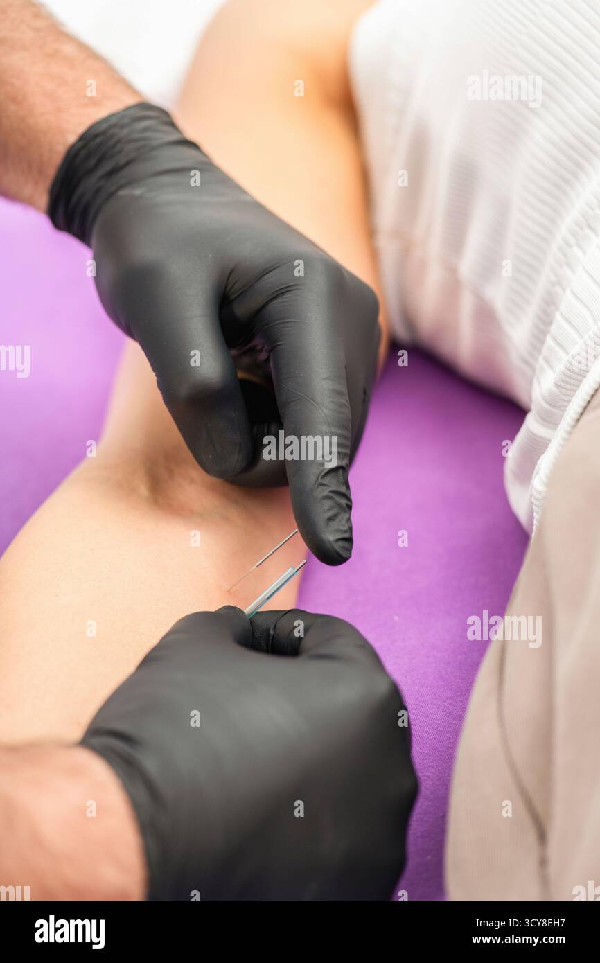 Donna che riceve una terapia con ago secco sul gomito durante una sessione di terapia fisica. Il trattamento mira alla tensione muscolare, al sollievo dal dolore e migliora la mobilità per la riabilitazione. Foto Stock