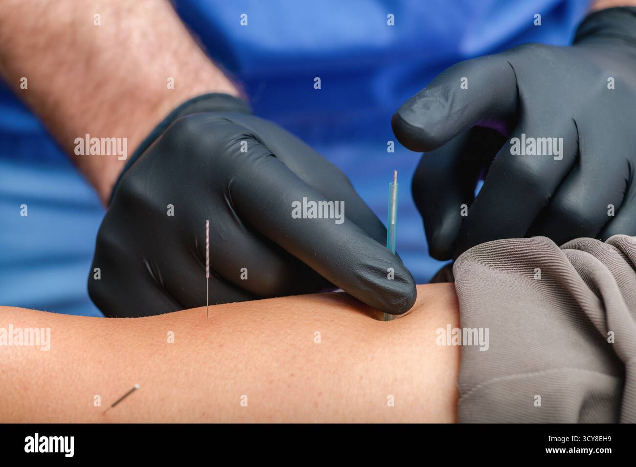 Donna che riceve una terapia con ago secco sul ginocchio durante una sessione di terapia fisica. Il trattamento mira alla tensione muscolare, al sollievo dal dolore e migliora la mobilità per la riabilitazione. Foto Stock