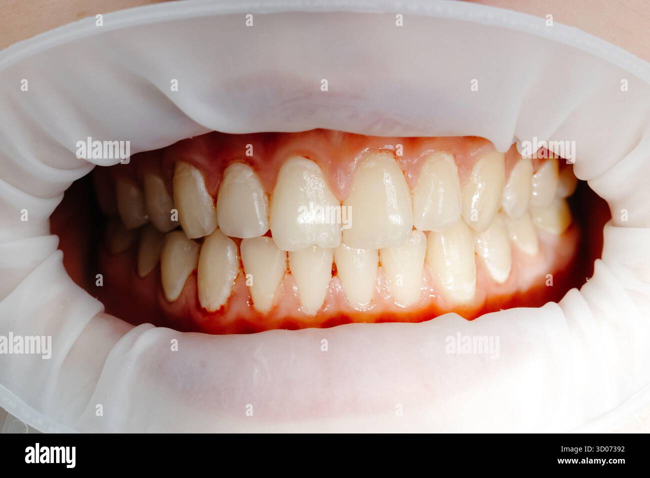 Primo piano dei denti del paziente durante l'esame odontoiatrico che mostra il divaricatore della guancia e gengive sane Foto Stock