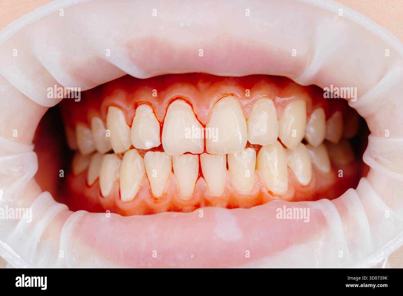 Primo piano dei denti del paziente durante l'esame odontoiatrico che mostra il divaricatore della guancia e gengive sane Foto Stock