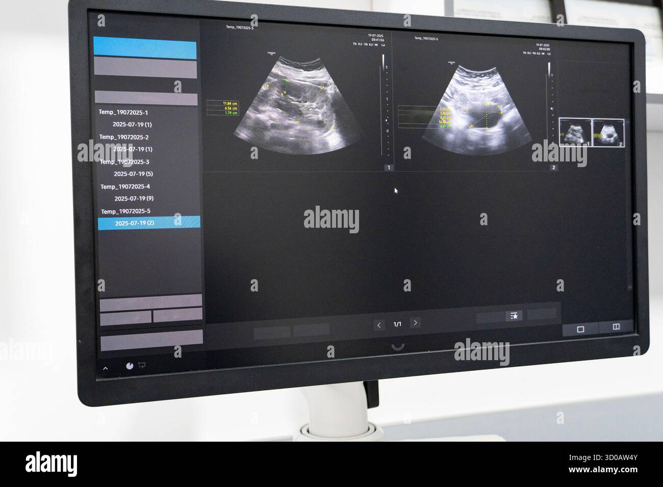 Display del monitor a ultrasuoni ad alta risoluzione che mostra immagini di scansione prenatale o addominale in un ambiente clinico Foto Stock