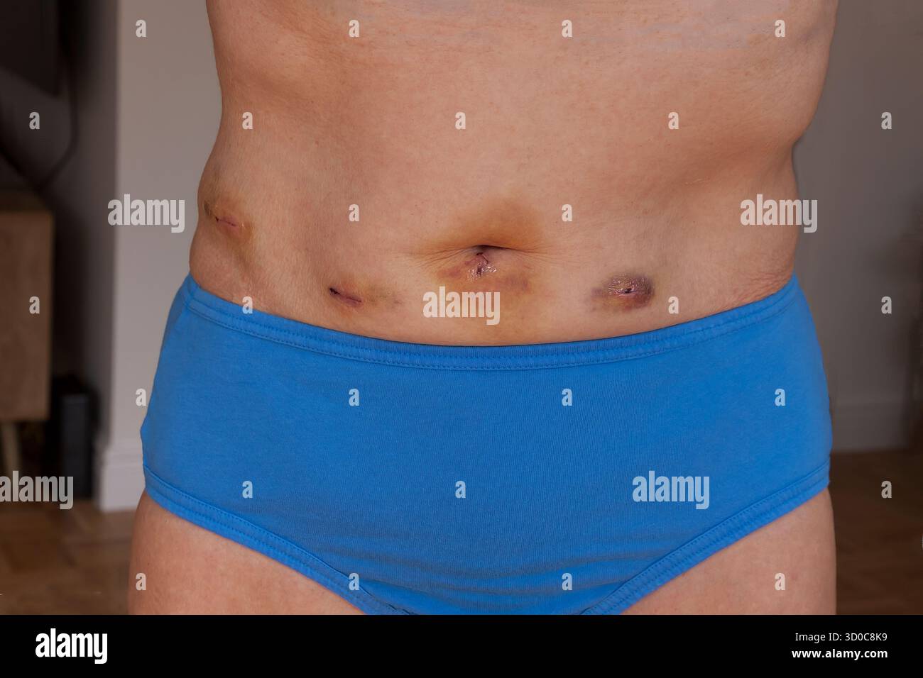 Dopo l'intervento di rimozione laparoscopica minimamente invasiva della colecisti, che mostra 5 piccole cicatrici da incisione (per un recupero più rapido). Foto Stock