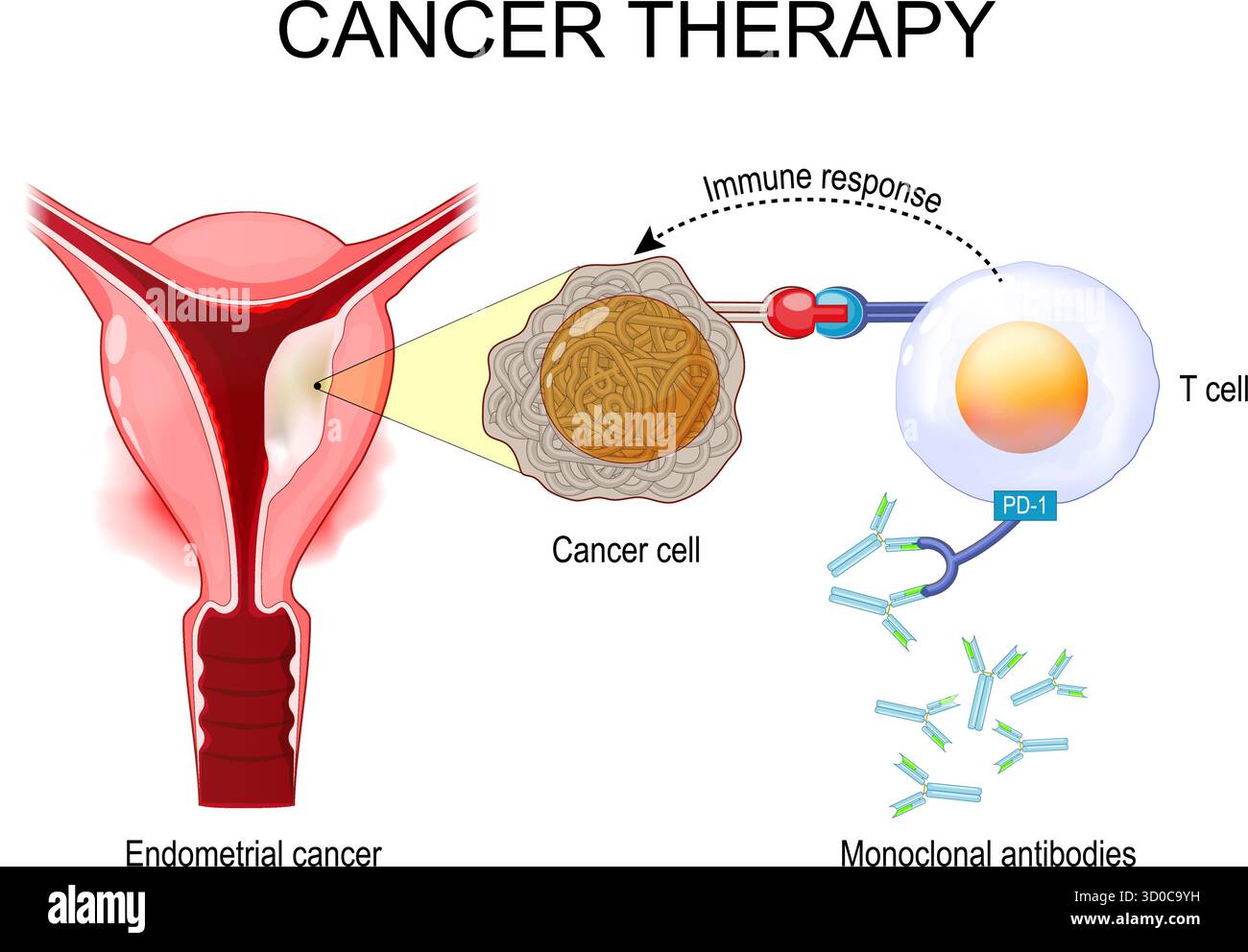 Terapia per il cancro endometriale. Sezione trasversale dell'utero umano con tumore. Anticorpi monoclonali nella terapia del cancro endometriale. Farmaci antitumorali. VEC Illustrazione Vettoriale