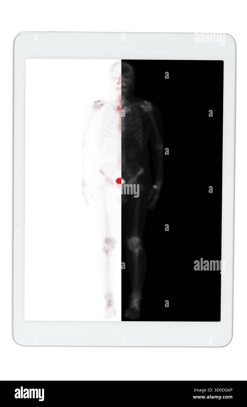 La scansione ossea dell'intero corpo sulla compressa è stata eseguita dopo l'iniezione endovenosa di TC-99m MDP, senza evidenza di metastasi ossee. Foto Stock