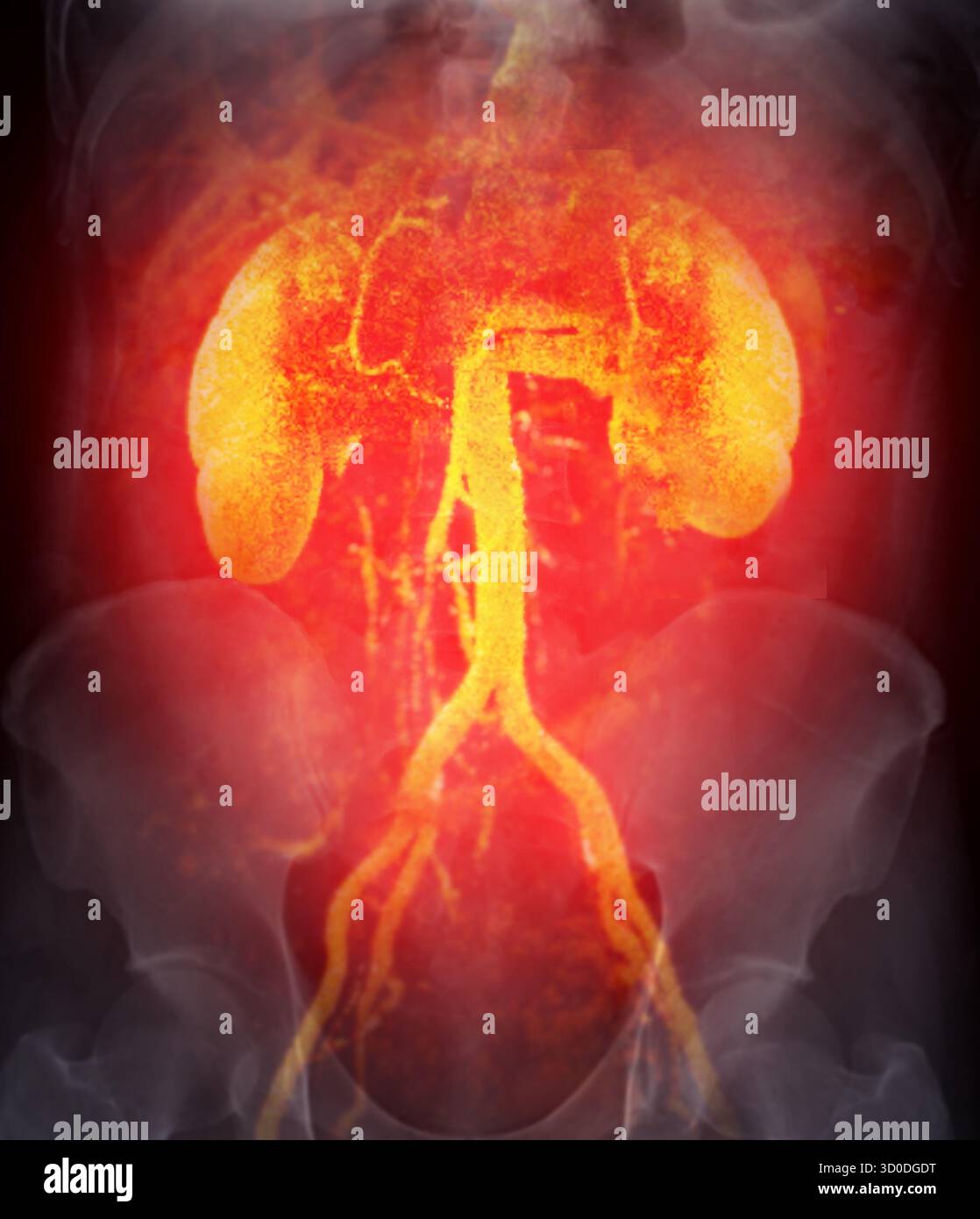 Una scansione radiografica che mostra i reni e le arterie renali, con una visione chiara della via arteriosa e della funzionalità renale sana. Foto Stock