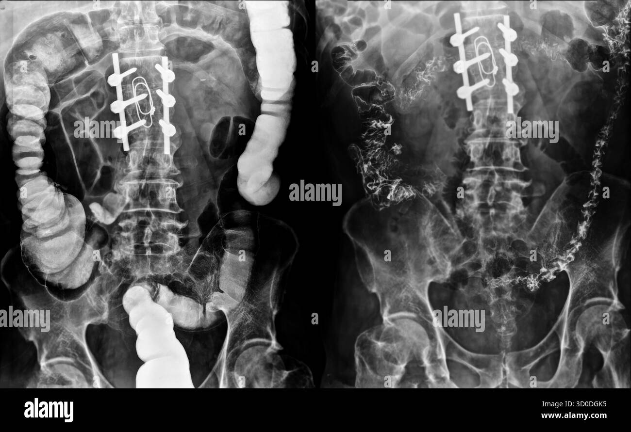 Enema bario a doppio contrasto che mostra una lieve scoliosi nella colonna lombare e alcuni diverticoli nel colon destro. Non ci sono segni di intestino Foto Stock