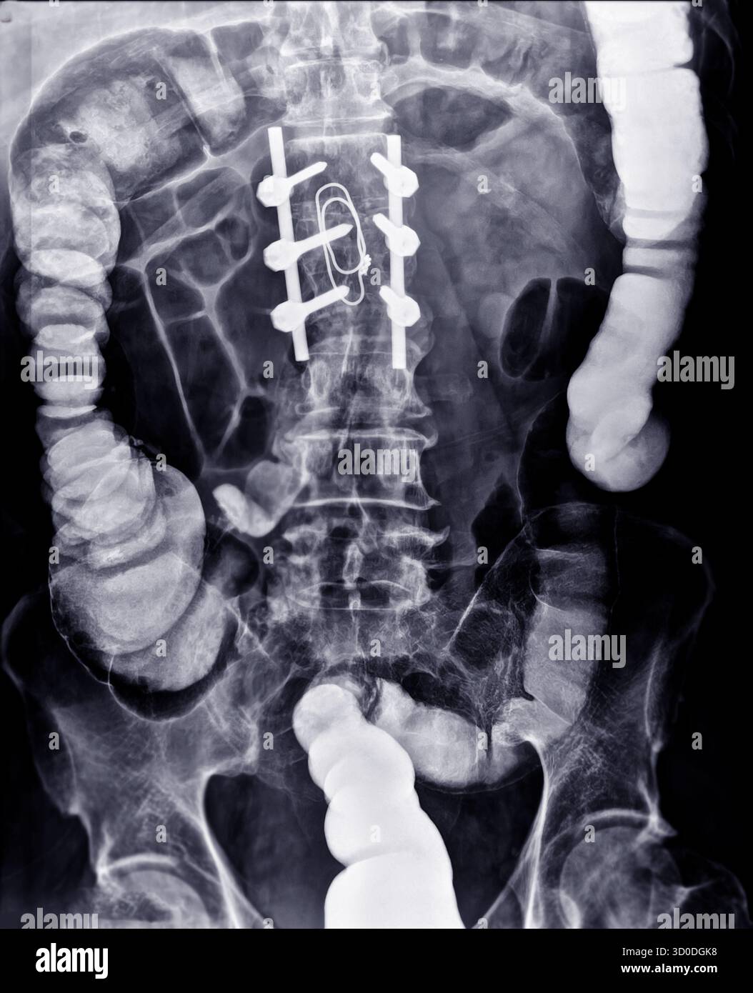 Enema bario a doppio contrasto che mostra una lieve scoliosi nella colonna lombare e alcuni diverticoli nel colon destro. Non ci sono segni di intestino Foto Stock
