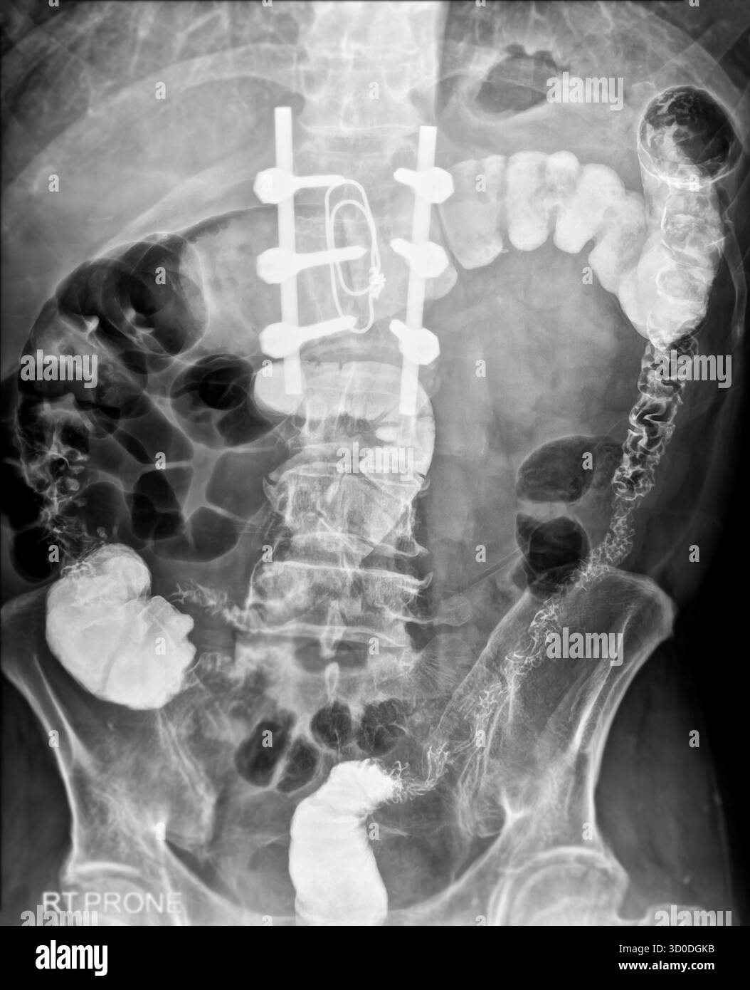 Enema bario a doppio contrasto che mostra una lieve scoliosi nella colonna lombare e alcuni diverticoli nel colon destro. Non ci sono segni di intestino Foto Stock