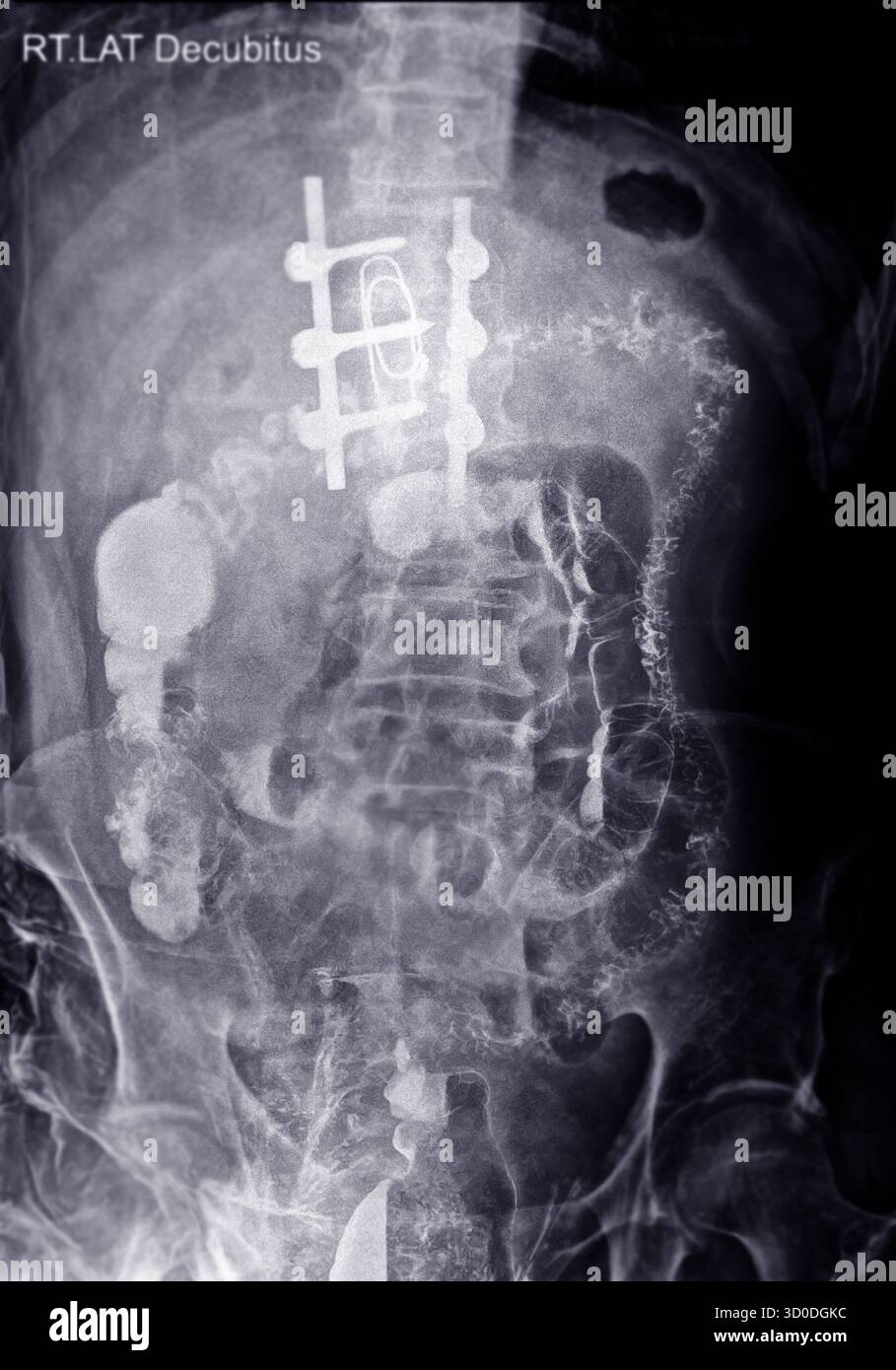 Enema bario a doppio contrasto che mostra una lieve scoliosi nella colonna lombare e alcuni diverticoli nel colon destro. Non ci sono segni di intestino Foto Stock