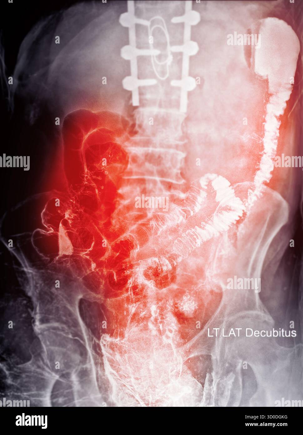Enema bario a doppio contrasto che mostra una lieve scoliosi nella colonna lombare e alcuni diverticoli nel colon destro. Non ci sono segni di intestino Foto Stock