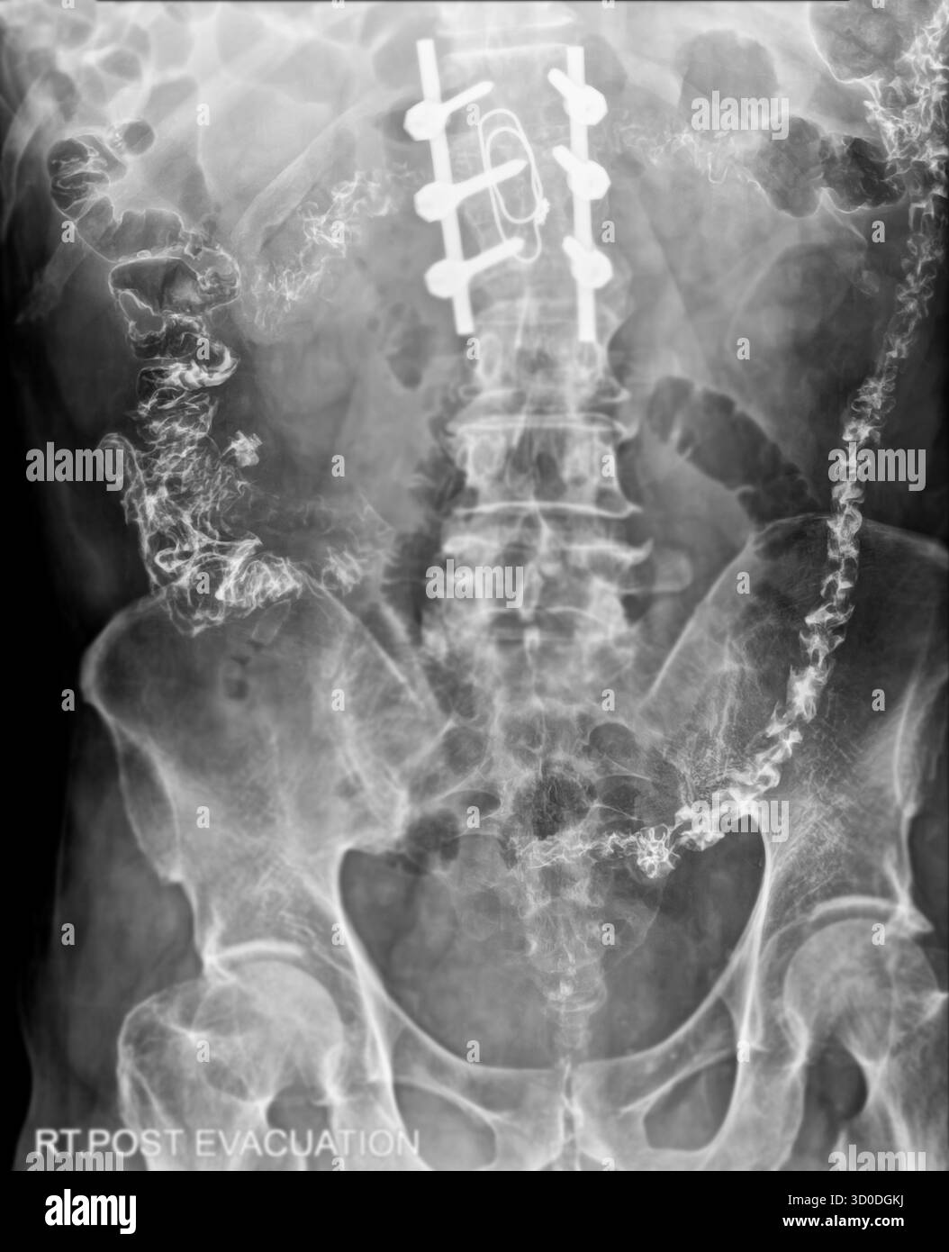 Enema bario a doppio contrasto che mostra una lieve scoliosi nella colonna lombare e alcuni diverticoli nel colon destro. Non ci sono segni di intestino Foto Stock