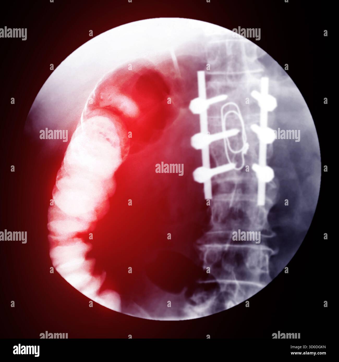 Enema bario a doppio contrasto che mostra una lieve scoliosi nella colonna lombare e alcuni diverticoli nel colon destro. Non ci sono segni di intestino Foto Stock