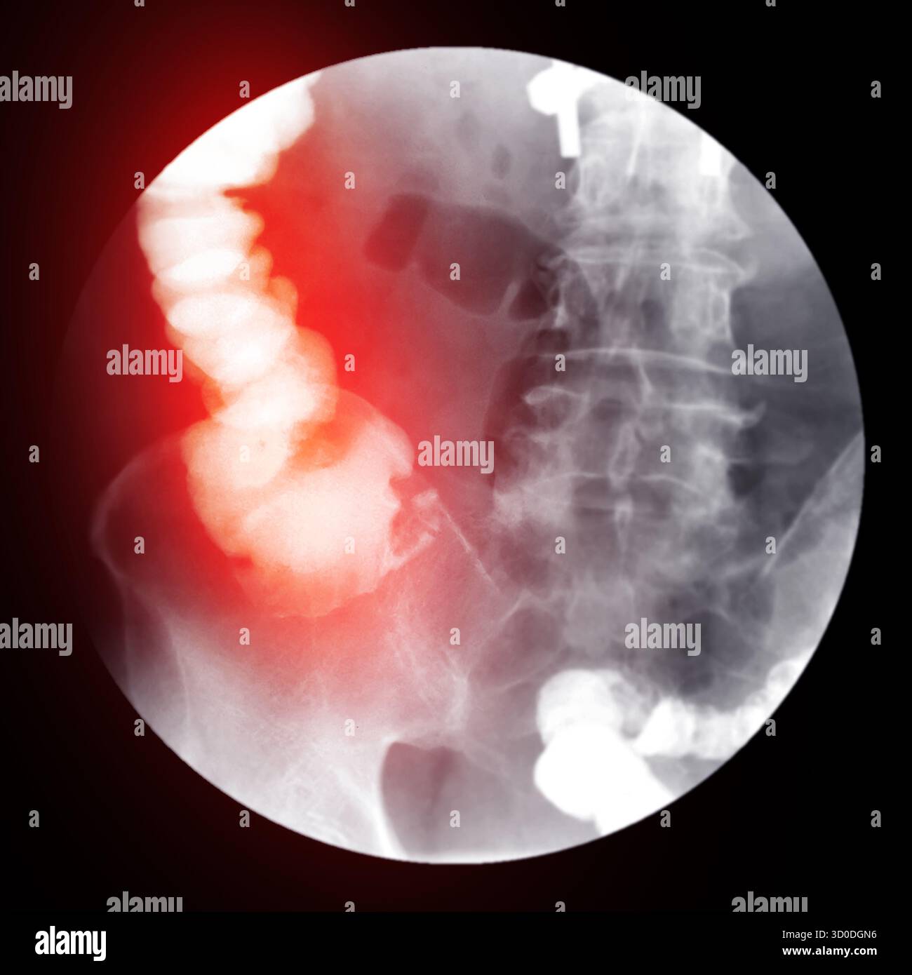 Enema bario a doppio contrasto che mostra una lieve scoliosi nella colonna lombare e alcuni diverticoli nel colon destro. Non ci sono segni di intestino Foto Stock