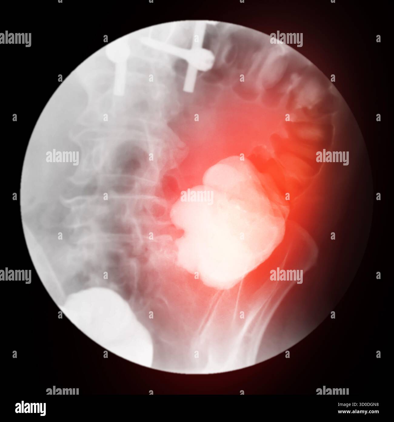 Enema bario a doppio contrasto che mostra una lieve scoliosi nella colonna lombare e alcuni diverticoli nel colon destro. Non ci sono segni di intestino Foto Stock