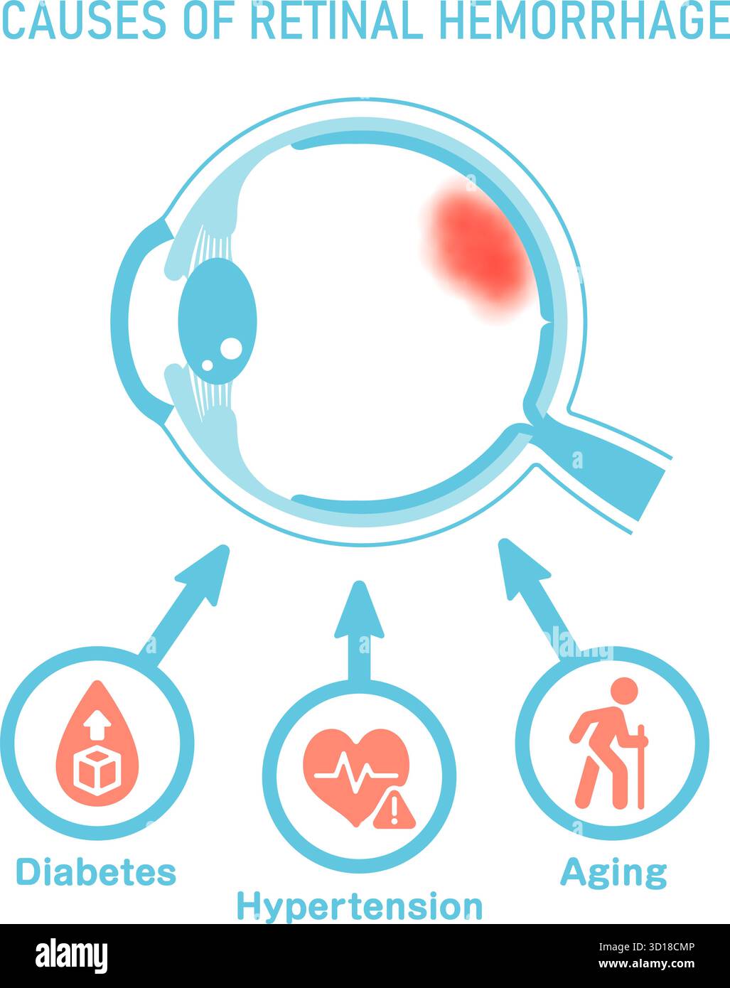 Cause di emorragia retinica. Illustrazione vettoriale. Illustrazione Vettoriale