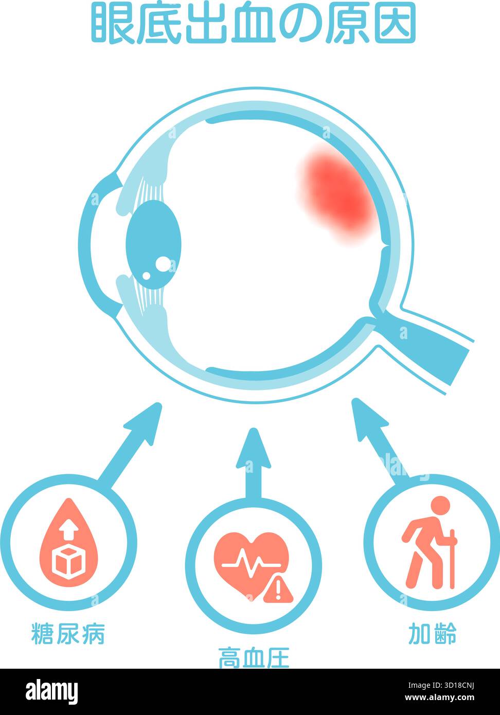 Cause di emorragia retinica. Illustrazione vettoriale. Illustrazione Vettoriale