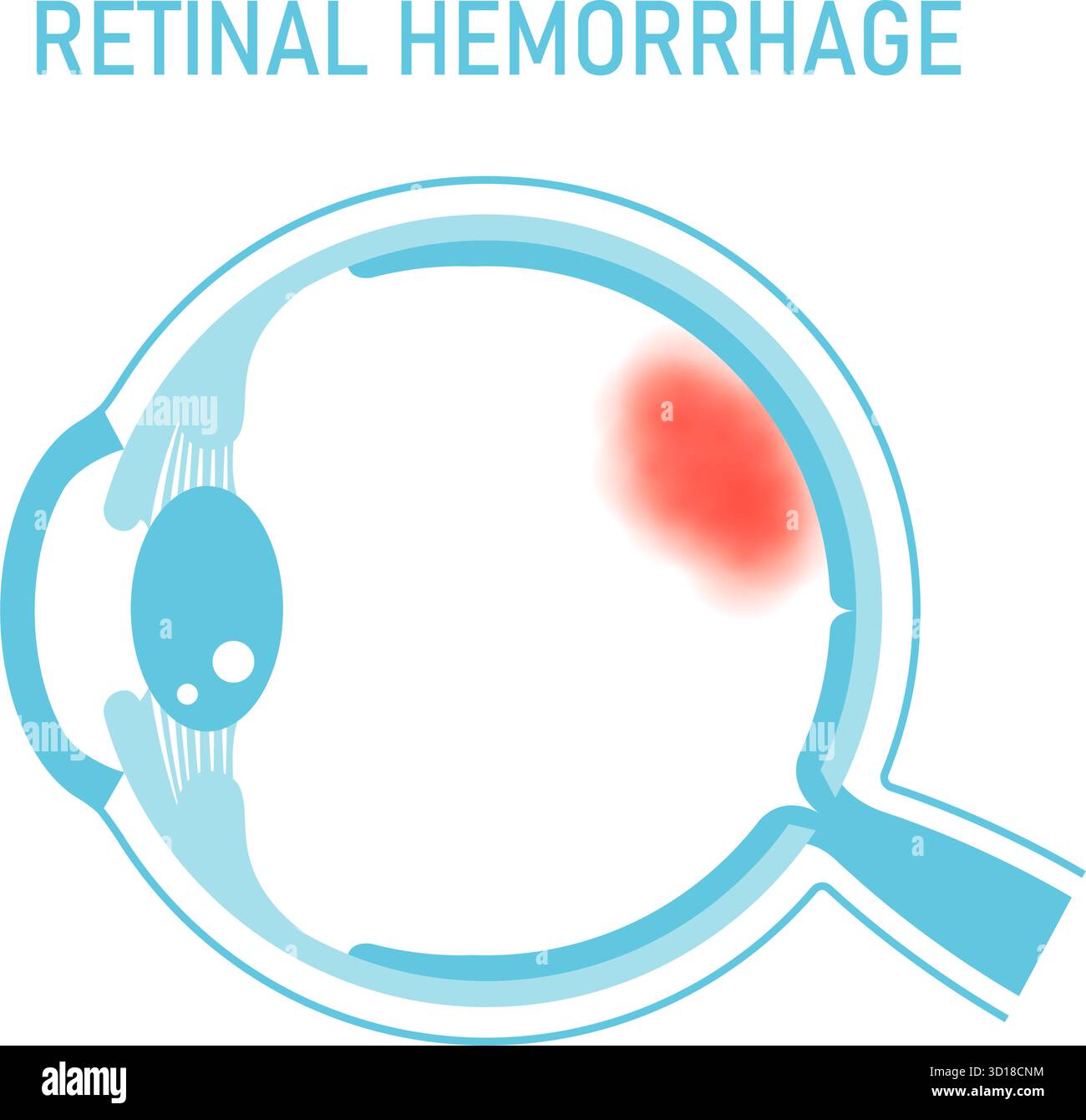 Illustrazione vettoriale di emorragia retinica Illustrazione Vettoriale