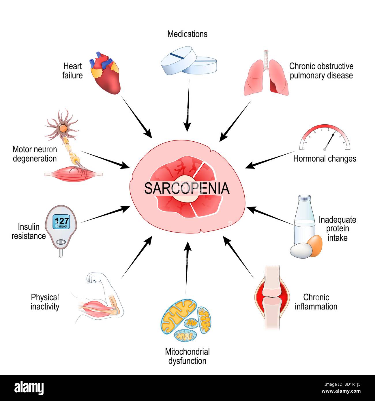 Sarcopenia. Perdita di massa muscolare. Declino muscolare correlato all'età. Illustrazione vettoriale Illustrazione Vettoriale