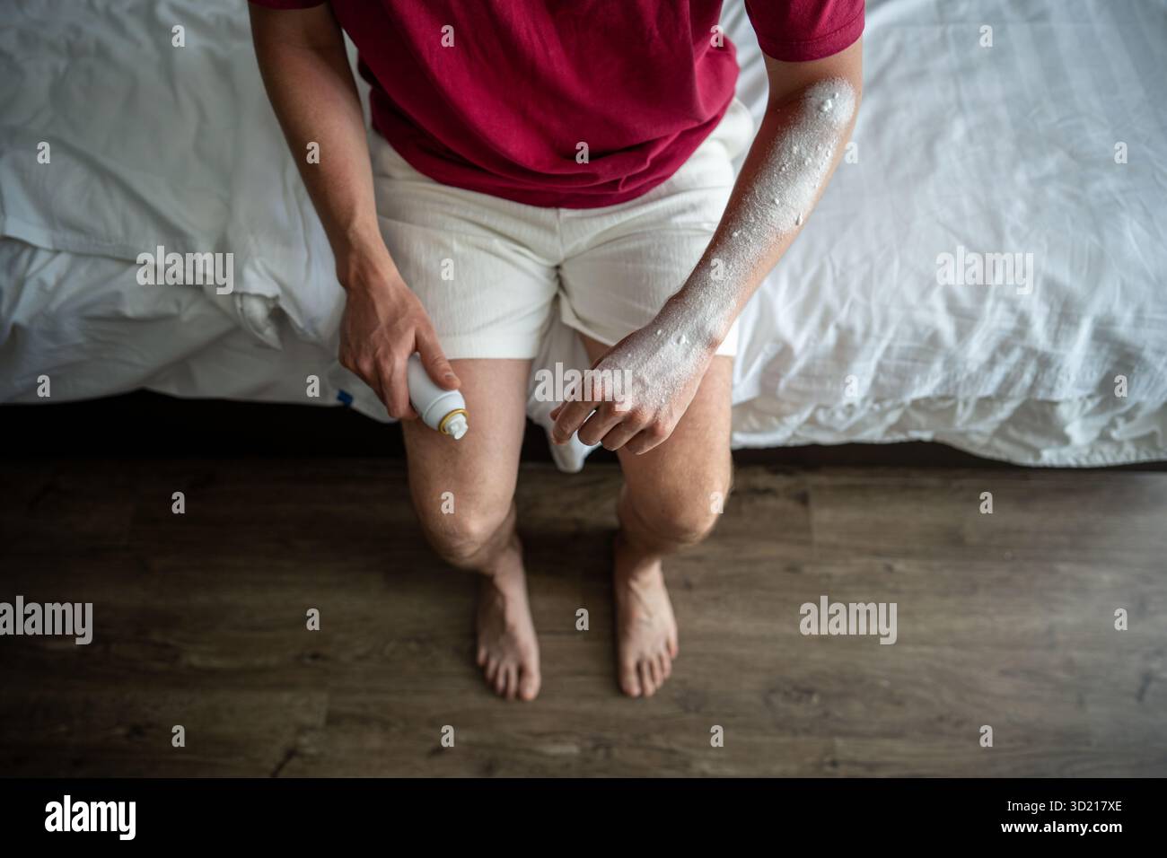 L'uomo spruzza la crema sul braccio bruciato dopo il sole duro. Aiuta il recupero della pelle guarigione, fastidio della pelle rossa Foto Stock