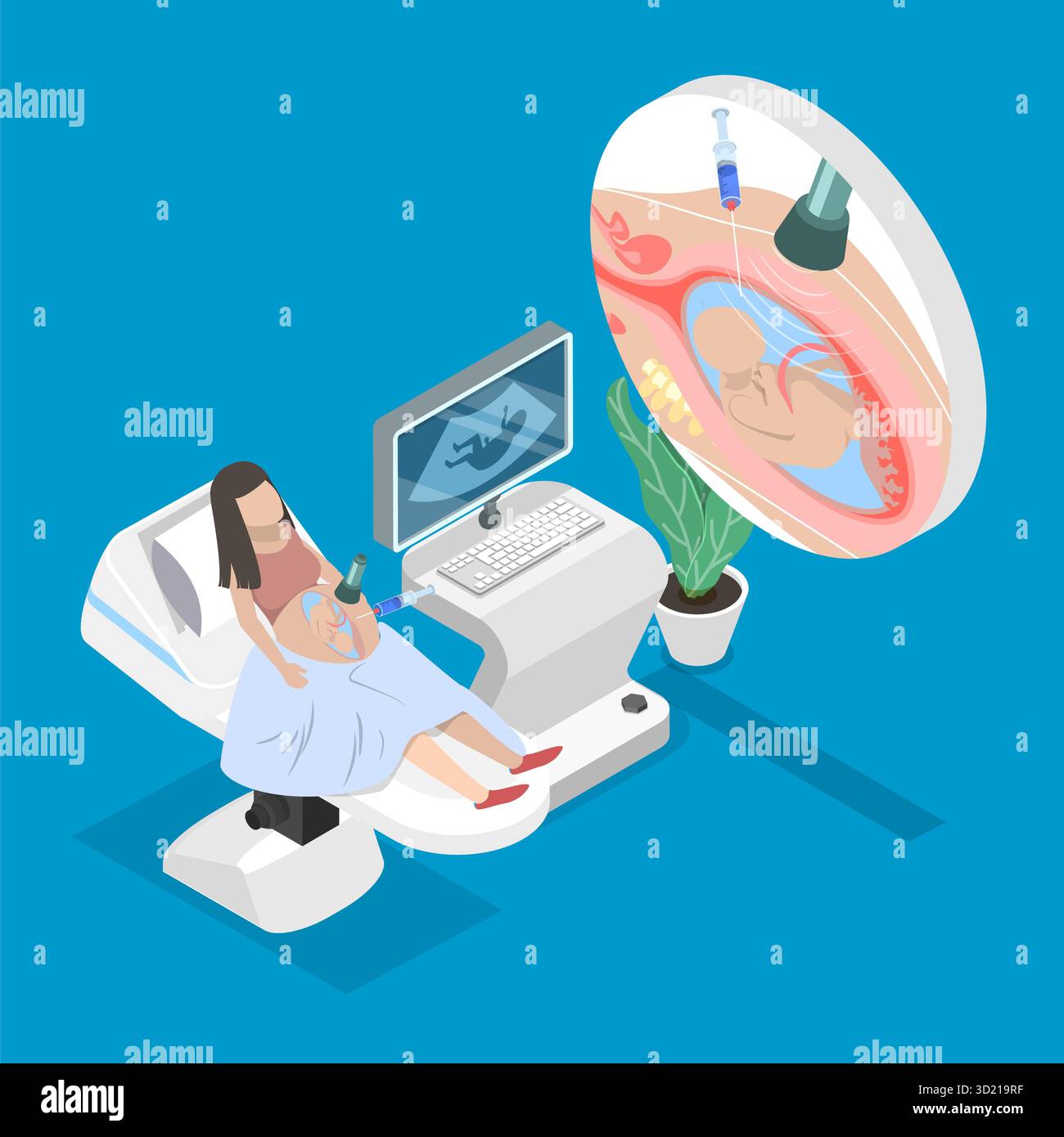 Illustrazione piatta isometrica 3D del test diagnostico di amniocentesi, disturbi genetici e anomalie fetali Foto Stock