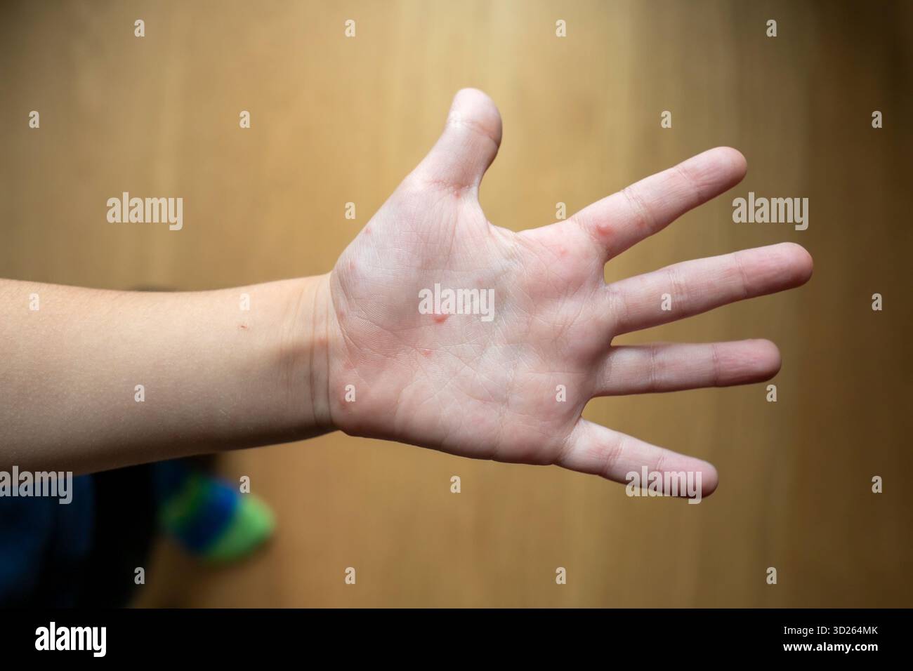 Il palmo del bambino rivela lesioni cutanee caratteristiche e un'eruzione maculopapulare, che indica sintomi di malattia della mano, dell'afta epizootica e della bocca causati da coxsackievirus, una comune infezione virale pediatrica Foto Stock