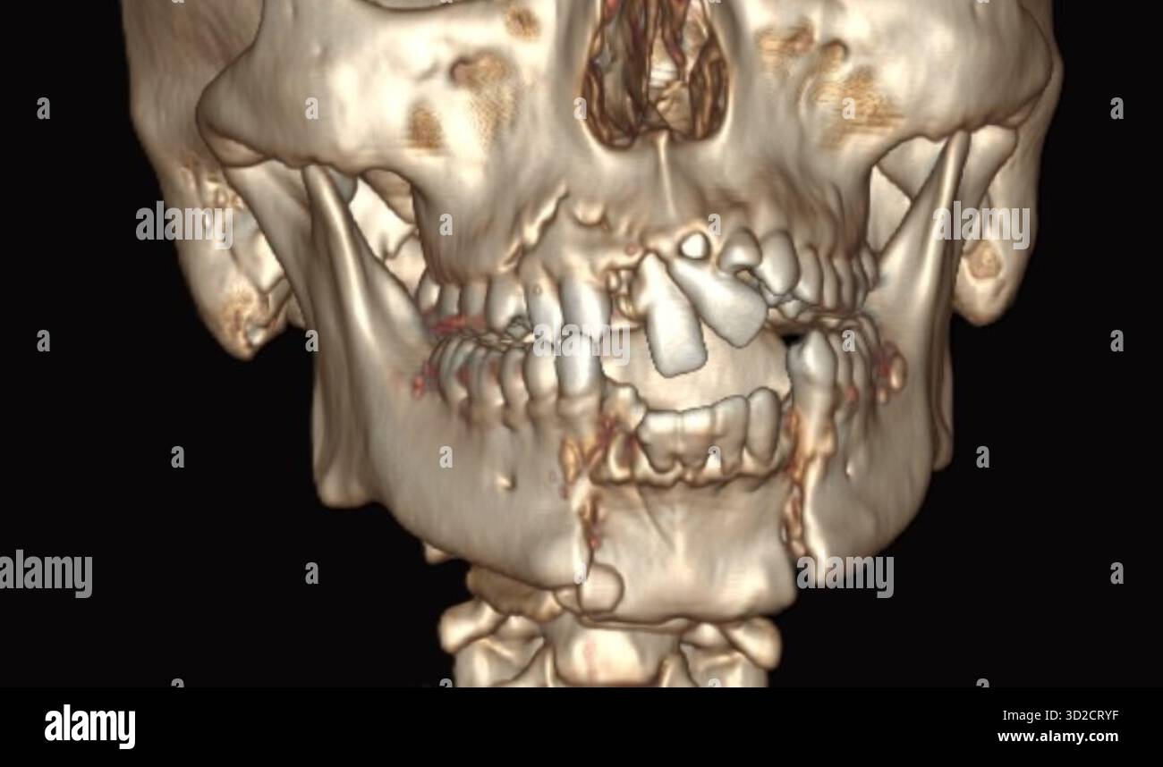 Tomografia computerizzata (TC) 3D colorata di una mandibola inferiore fratturata (mandibola). Foto Stock