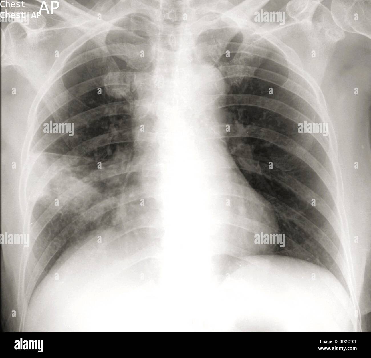 Polmone del pus immagini e fotografie stock ad alta risoluzione - Alamy