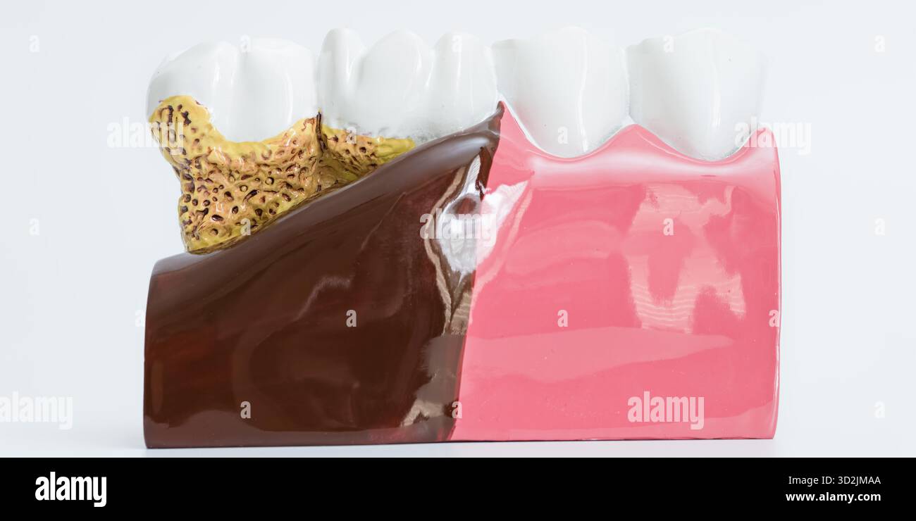 Modello dentale che confronta la malattia parodontale avanzata con perdita ossea e recessione da un lato, e gengive sane dall'altro. Foto Stock