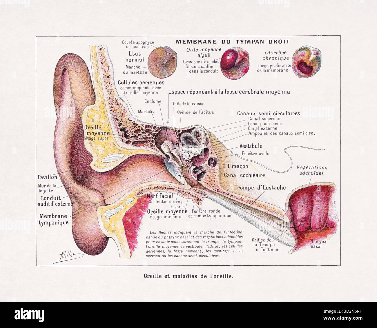 Illustrazione medica a colori di Adolphe Philippe Millot sul tema delle orecchie e delle loro malattie. Foto Stock
