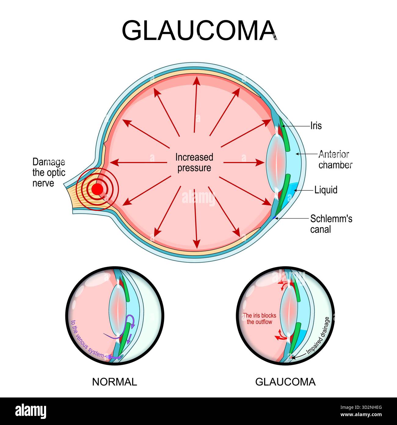 Glaucoma. Sezione trasversale dell'occhio umano con il canale di Schlemm, danno al nervo ottico, camera anteriore e aumento della pressione. Illustrazione vettoriale Illustrazione Vettoriale