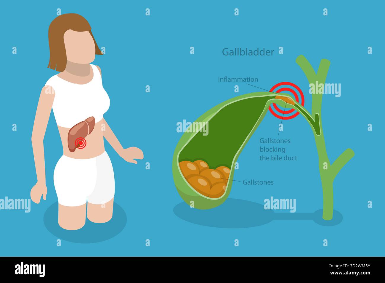 Illustrazione concettuale piatta isometrica 3D della malattia del gallstone, formazioni nella cistifellea illustrazione concettuale piatta isometrica 3D della malattia del gallstone, formazioni nella cistifellea Foto Stock