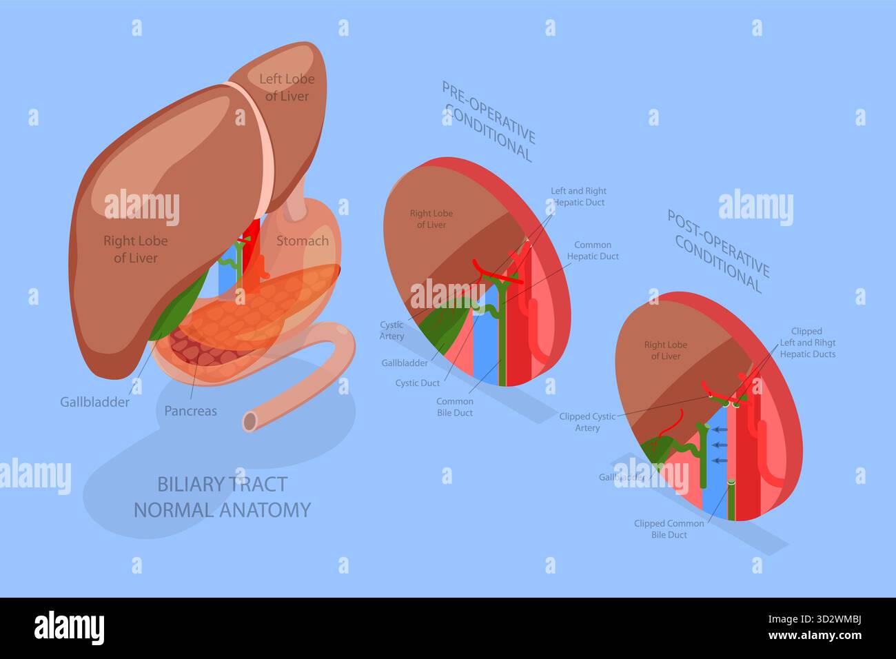 Illustrazione concettuale isometrica piatta 3D di chirurgia di rimozione della cistifellea, colecistectomia illustrazione concettuale isometrica piatta 3D di chirurgia di rimozione della cistifellea, colecistectomia Foto Stock
