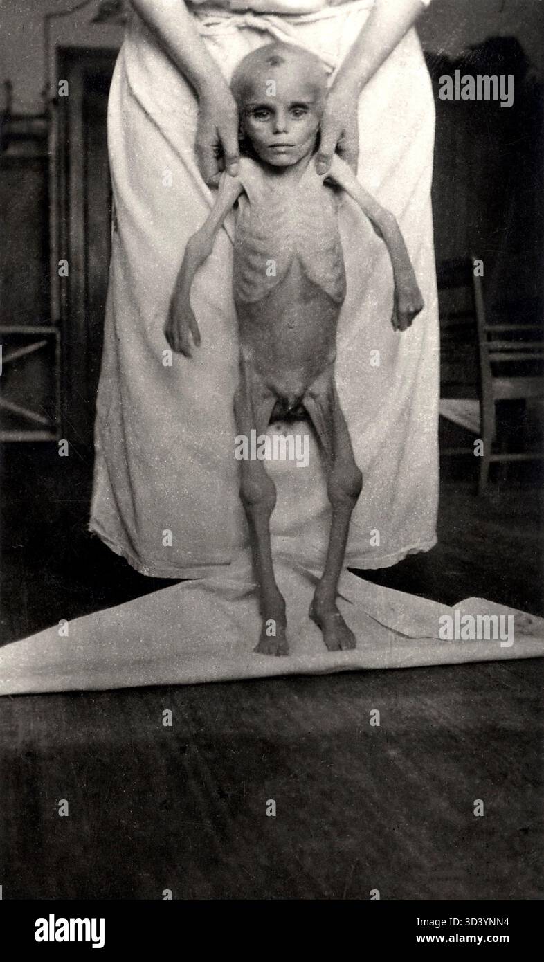 Nel 1920, un ragazzo malnutrito di 18 mesi all'Orfanotrofio di Berlino, in Germania, mostrando i gravi effetti della denutrizione. La foto evidenzia le sfide del benessere dei bambini nella Germania post-bellica. Foto Stock