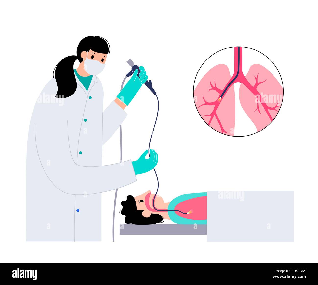 Illustrazione di una procedura broncoscopica. Ciò comporta l'inserimento di un tubo lungo, sottile e flessibile chiamato broncoscopio attraverso il naso o la bocca per esaminare il tubo del vento e le vie aeree. Viene utilizzato per diagnosticare le condizioni polmonari fornendo una visione chiara del rivestimento polmonare e consentire il prelievo di campioni di tessuto o fluido per analisi di laboratorio. Foto Stock